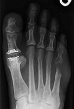 Silastic MTP joint arthroplasty